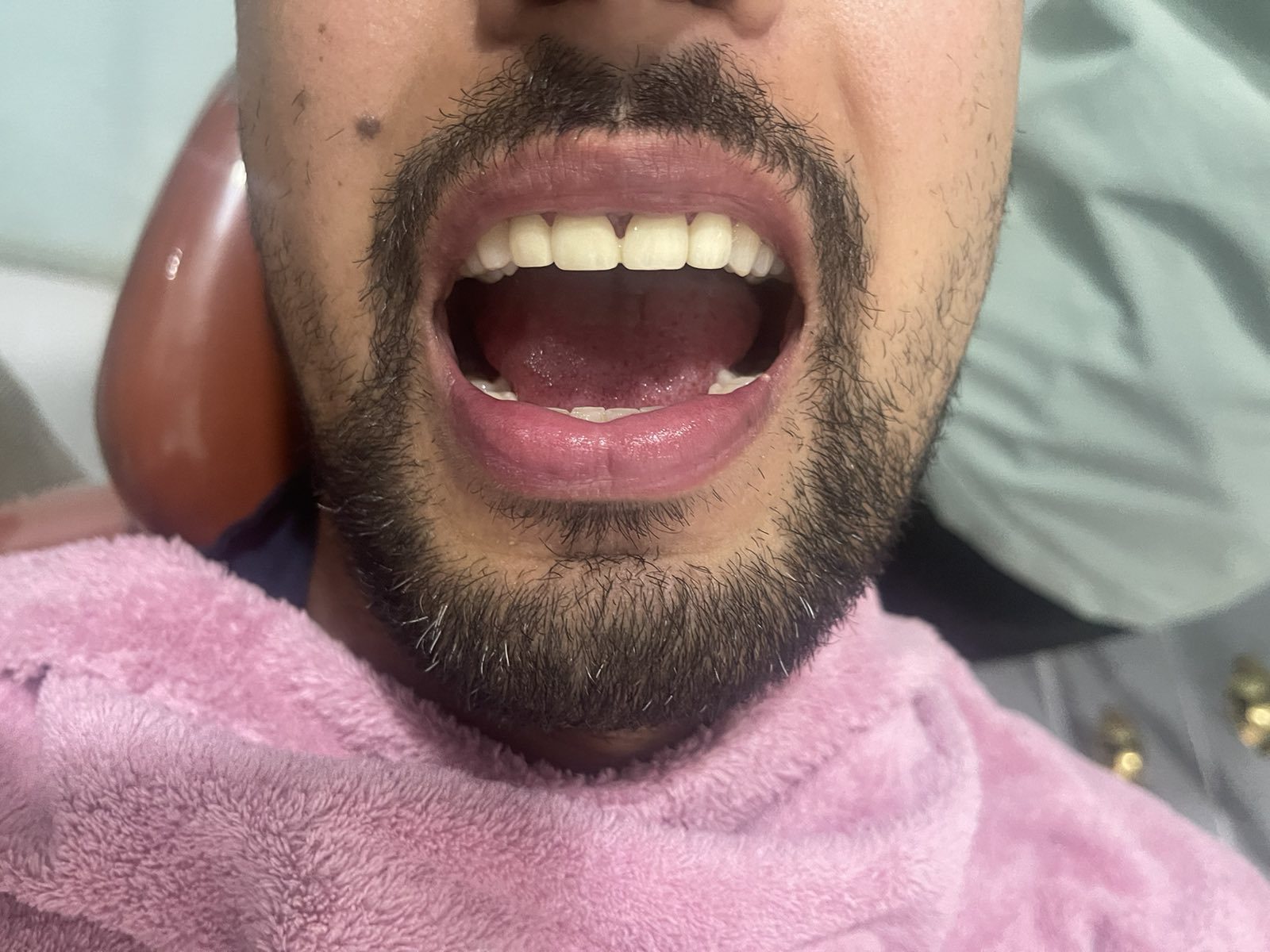 AFTER BB